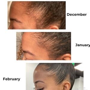 Hair Growth Progress Photos - Three Month Documentation
